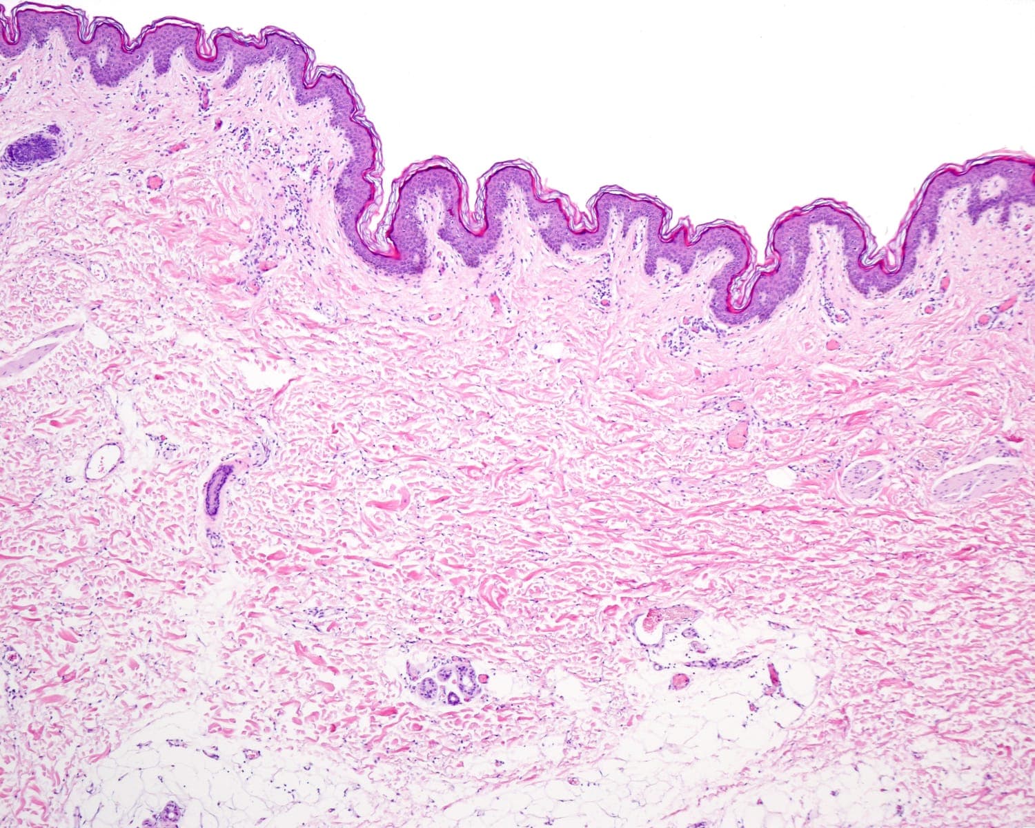 H&E-stained histological cross-section of skin showing the purple epidermis and the pink dermal collagen bundles that collagenase remodels