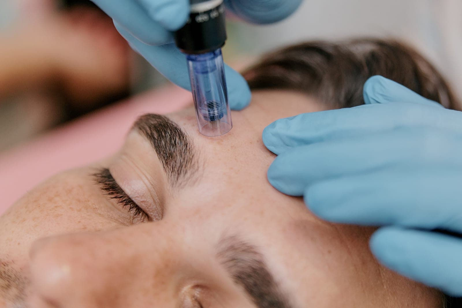 Close-up of a microneedling pen being applied to skin during a professional aesthetic treatment