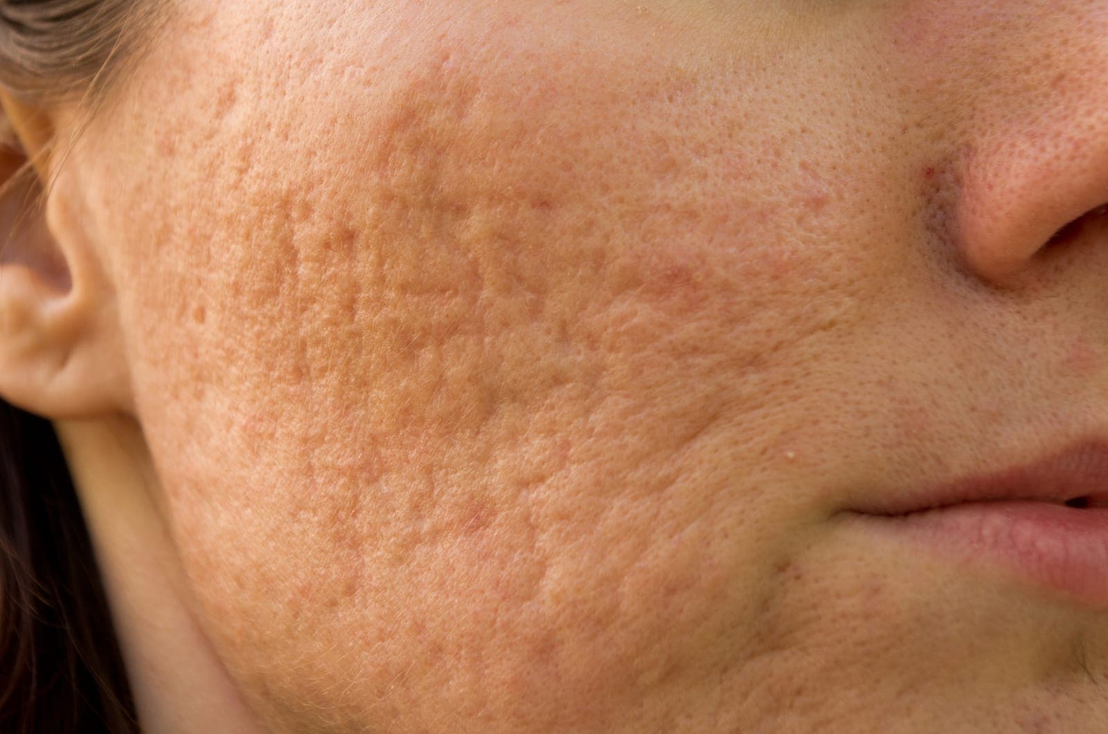 Close-up of atrophic acne scars on the cheek — the fibrotic tissue collagenase targets