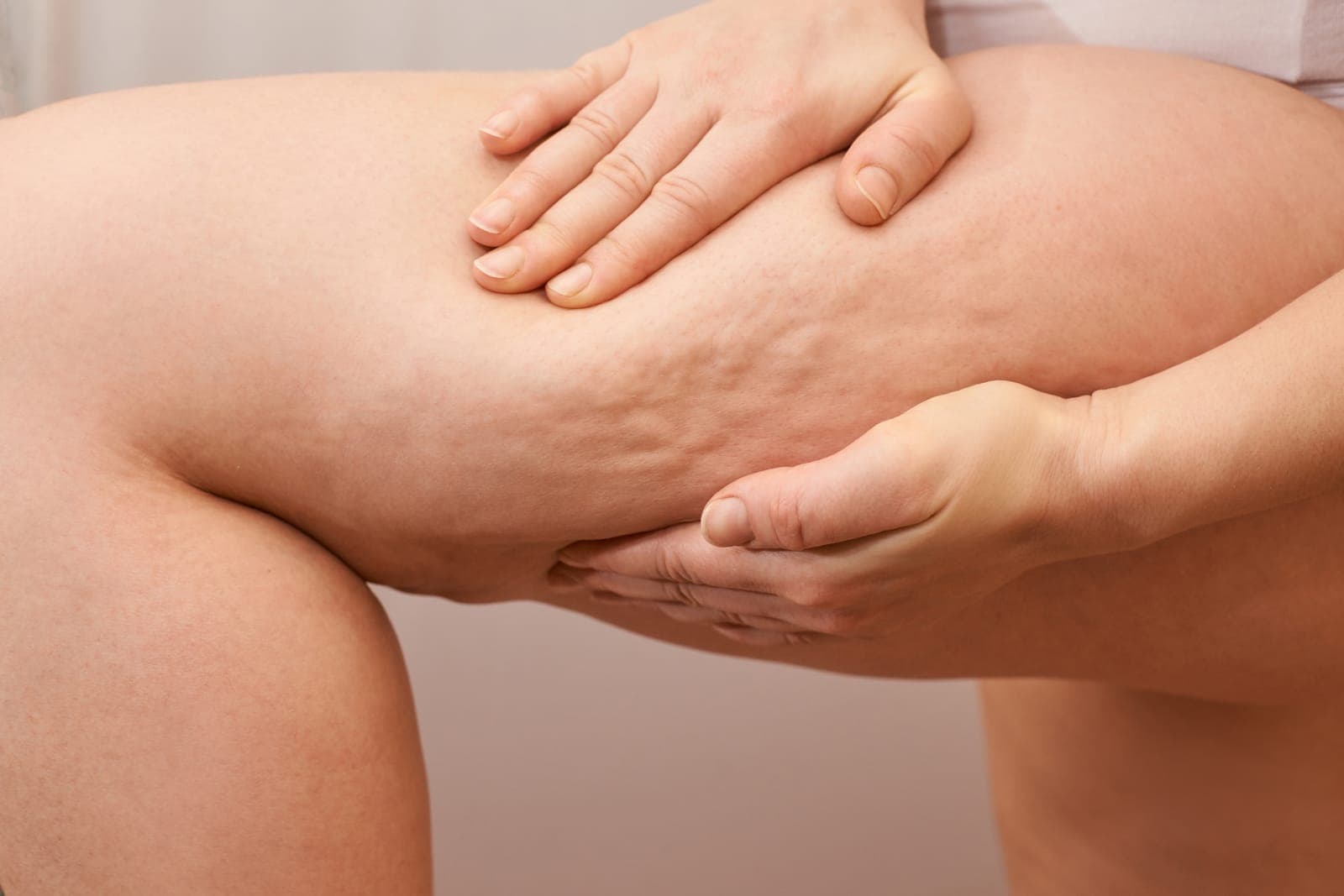 Close-up of cellulite dimples on the thigh — the ECM congestion lyase helps decongest