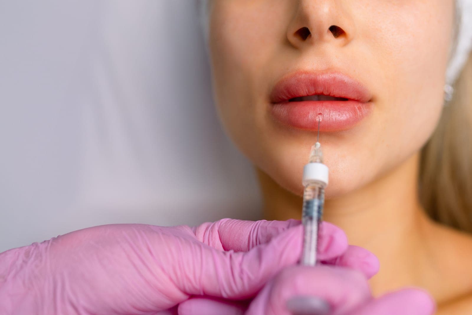 Close-up of lip filler injection — the treatment context hyaluronidase refines post-procedure